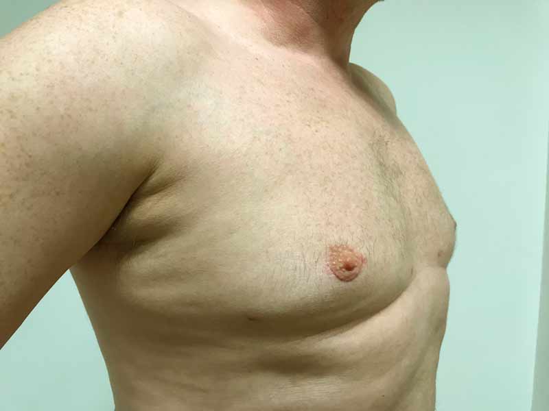 Before and after photos of gynaecomastia correction