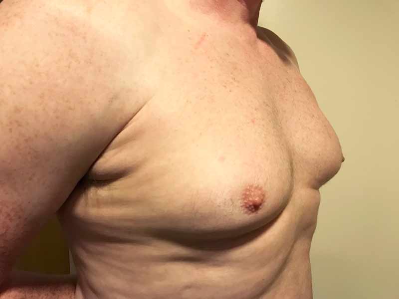 Before and after photos of gynaecomastia patient