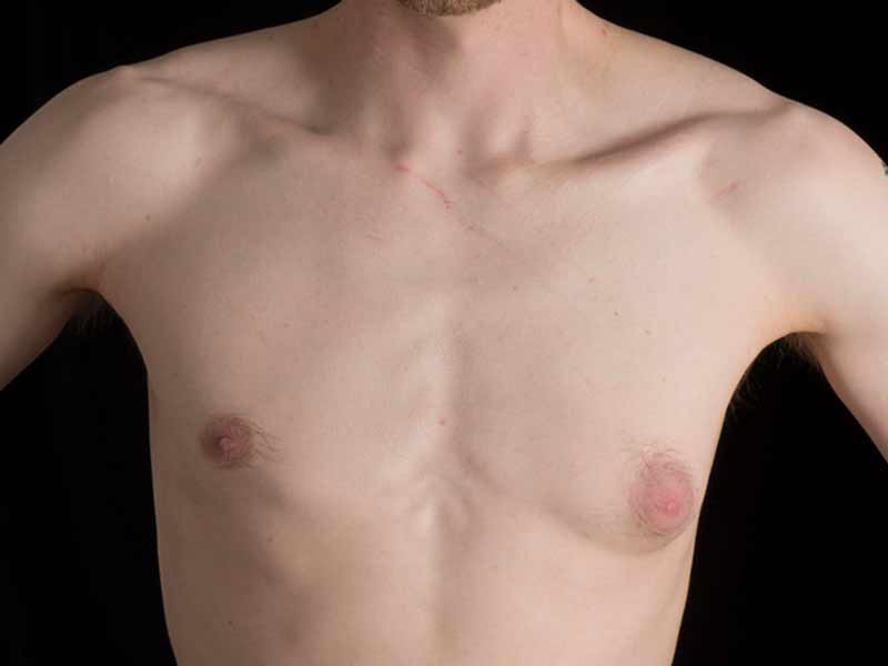 Before and after photos of unilateral gynaecomastia correction