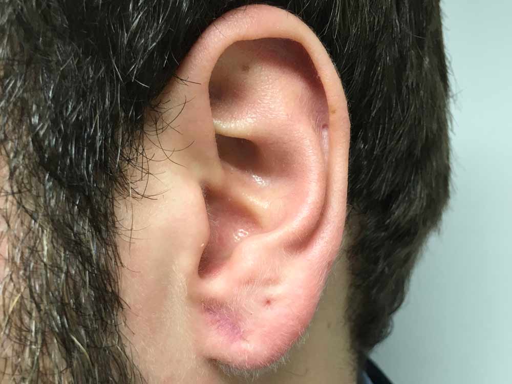 Before and after photos of split earlobe repair