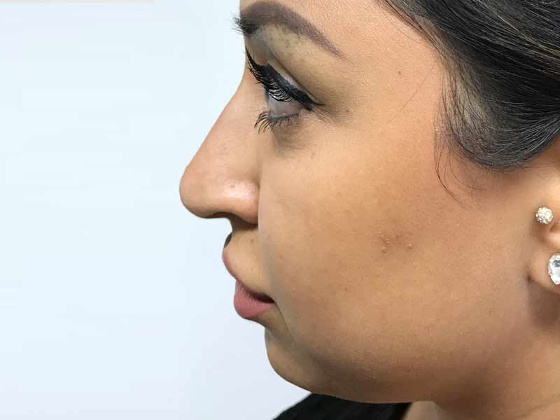 Before and after nose filler
