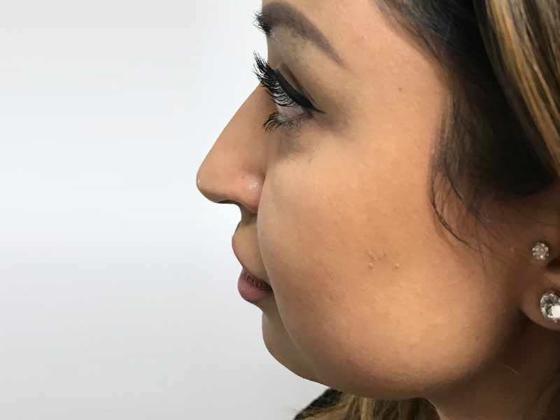 before and after nose filler