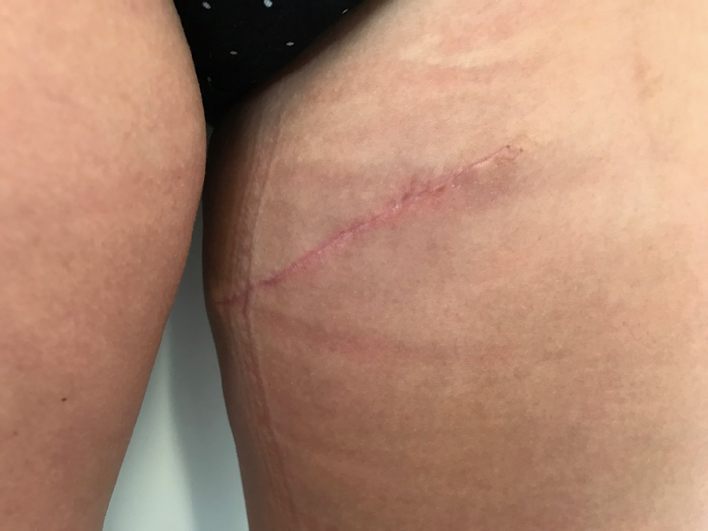 Postop thigh scar revision