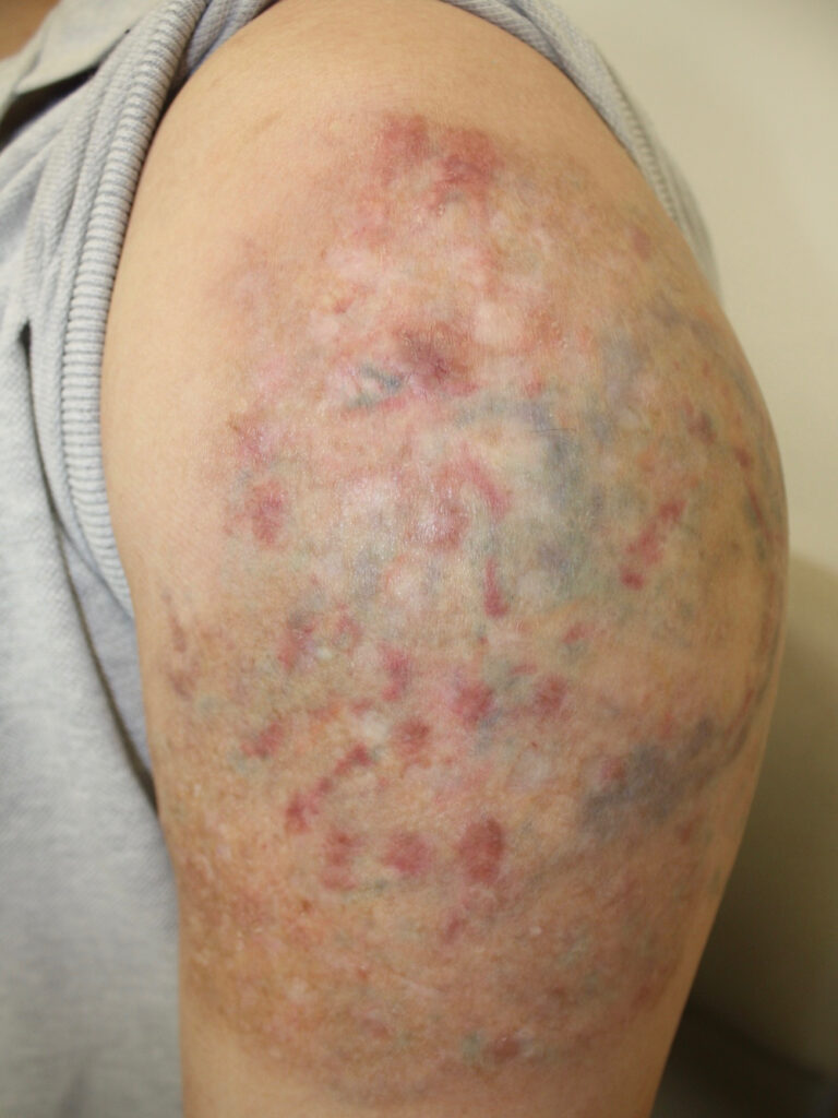 post steroid hypertrophic scar