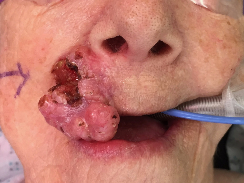 skin cancer to upper lip
