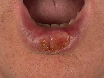 lower lip skin cancer