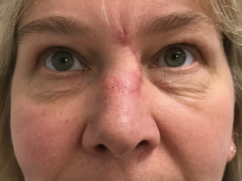 6 months after photo of skin cancer excision and reconstruction